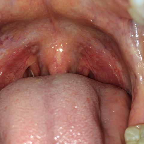 Ist Mein Rachen Rot Gesundheit Medizin Hals Ist Mein Rachen Rot Gesundheit Medizin Hals