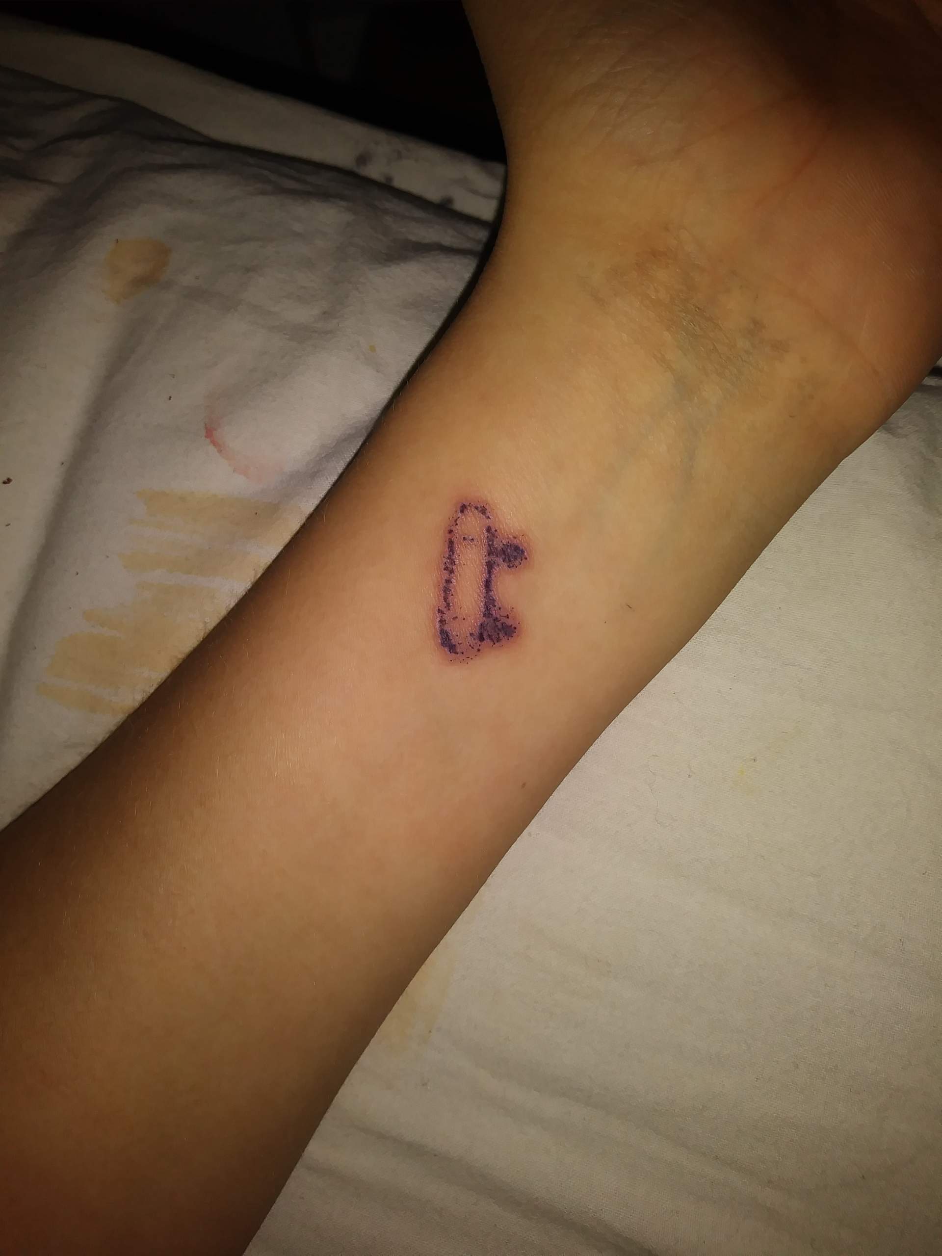 Ist mein Tattoo entzündet? Blutvergiftung? (Dummheit)