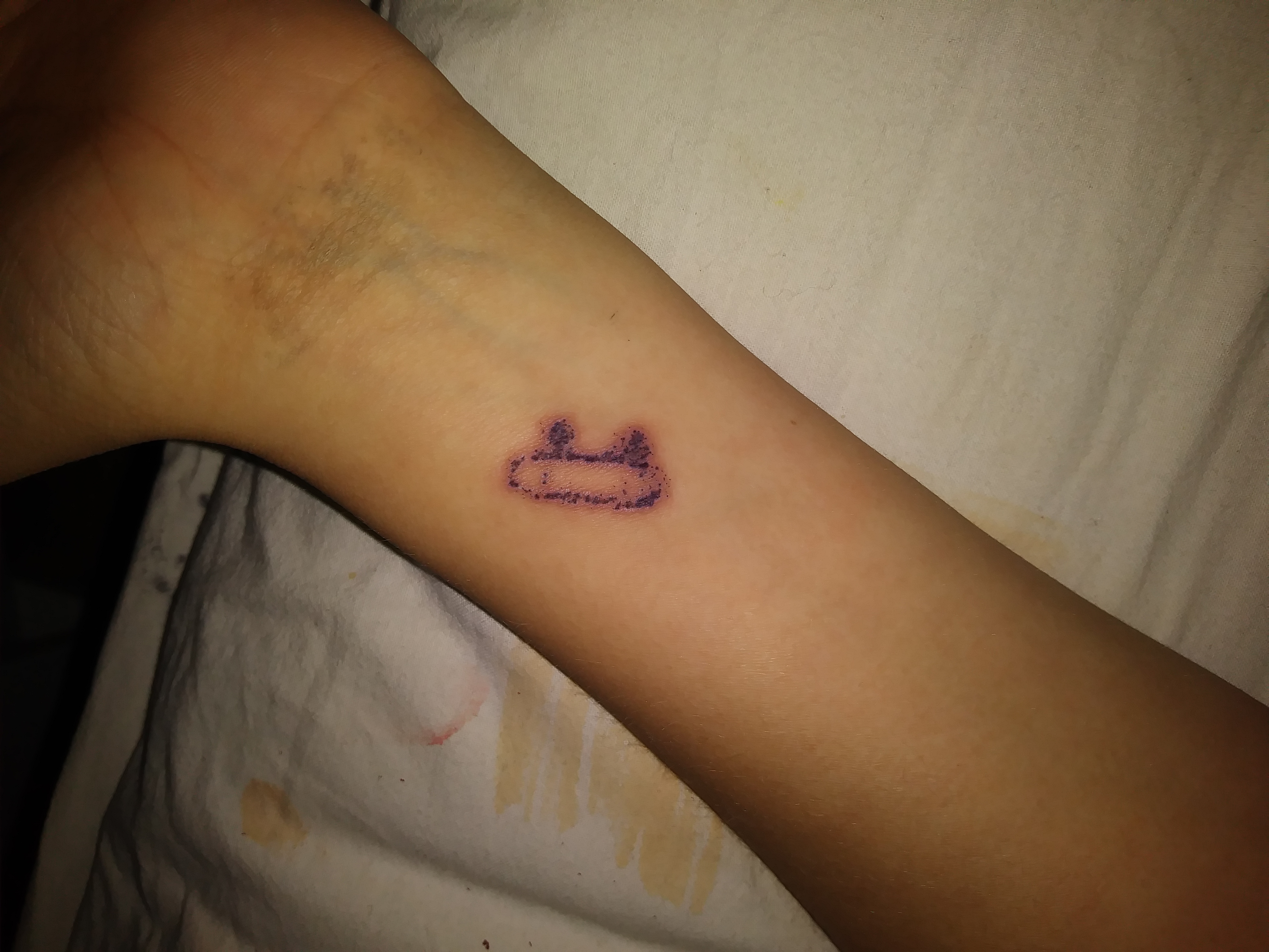 Ist mein Tattoo entzündet? Blutvergiftung?