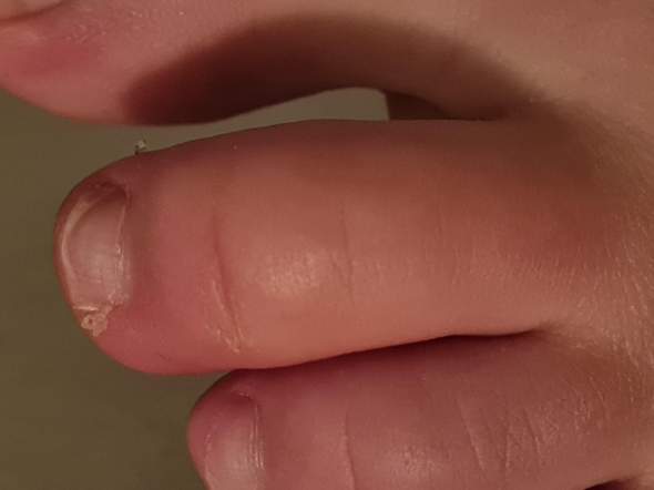 Ist Mein Zeh Gebrochen Gesundheit Und Medizin Gebrochener Zeh Ist Mein Zeh Gebrochen Gesundheit Und Medizin Gebrochener Zeh