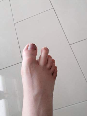 Ist Mein Zeh Gebrochen Und Wie Lange Kann Ich Warten Gesundheit Und Medizin Ist Mein Zeh Gebrochen Und Wie Lange Kann Ich Warten Gesundheit Und Medizin