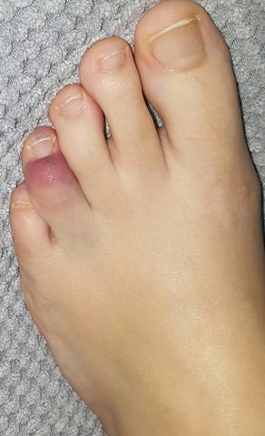 Ist Mein Zeh Gebrochen Soll Ich Zum Doc Gesundheit Korper Ist Mein Zeh Gebrochen Soll Ich Zum Doc Gesundheit Korper