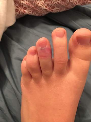 Ist Mein Zeh Womoglich Gebrochen Medizin Ist Mein Zeh Womoglich Gebrochen Medizin