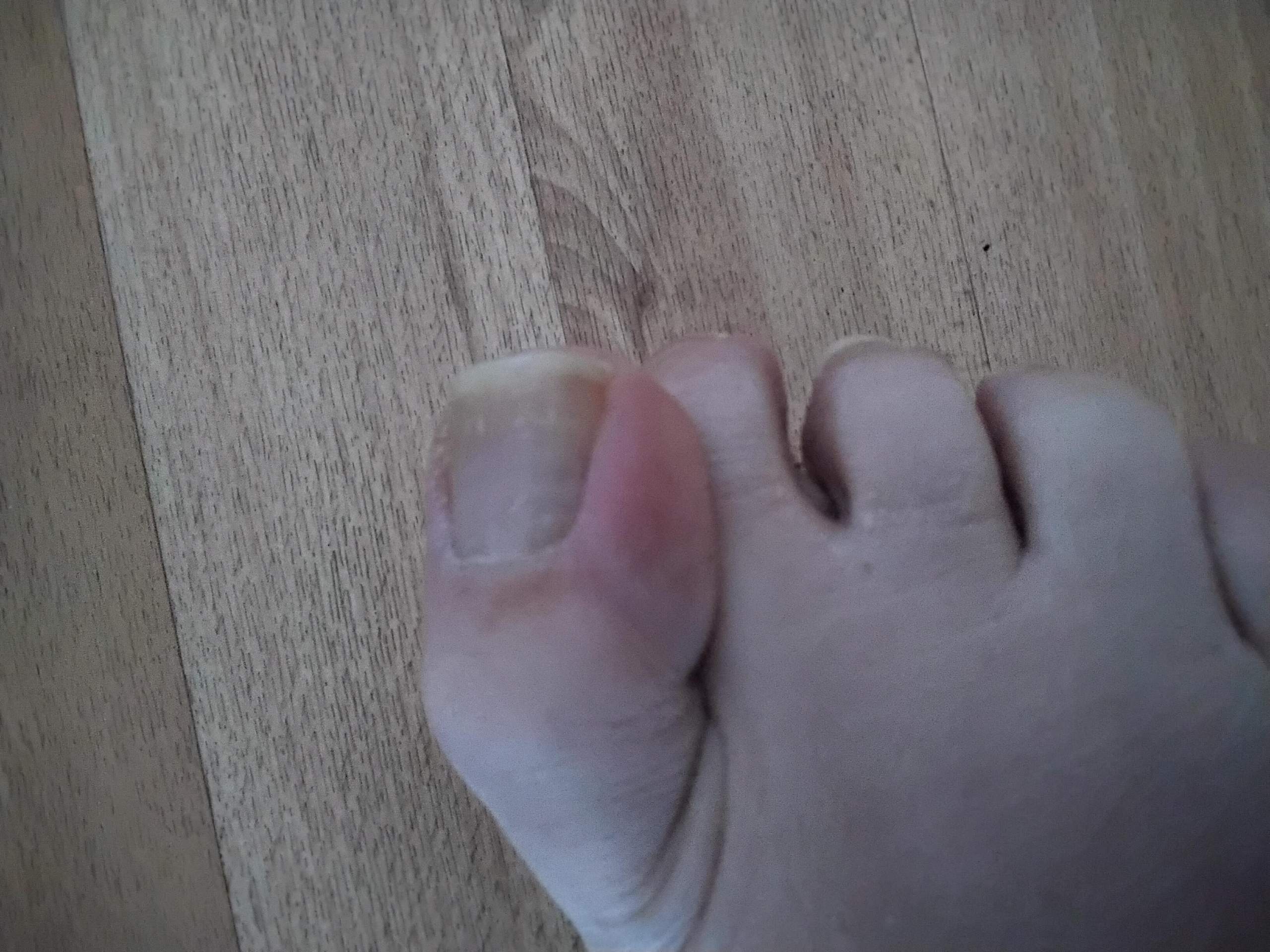 Ist mein Zehennagel eingewachsen, wenn ja, was tun? Ist mein Zehennagel eingewachsen, wenn ja, was tun?