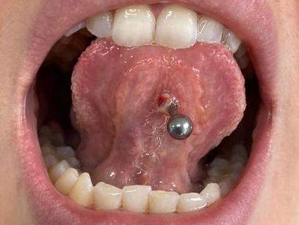 Ist mein Zungenpiercing entzündet?