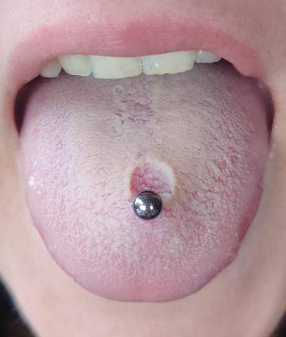 Ist mein Zungenpiercing normal?