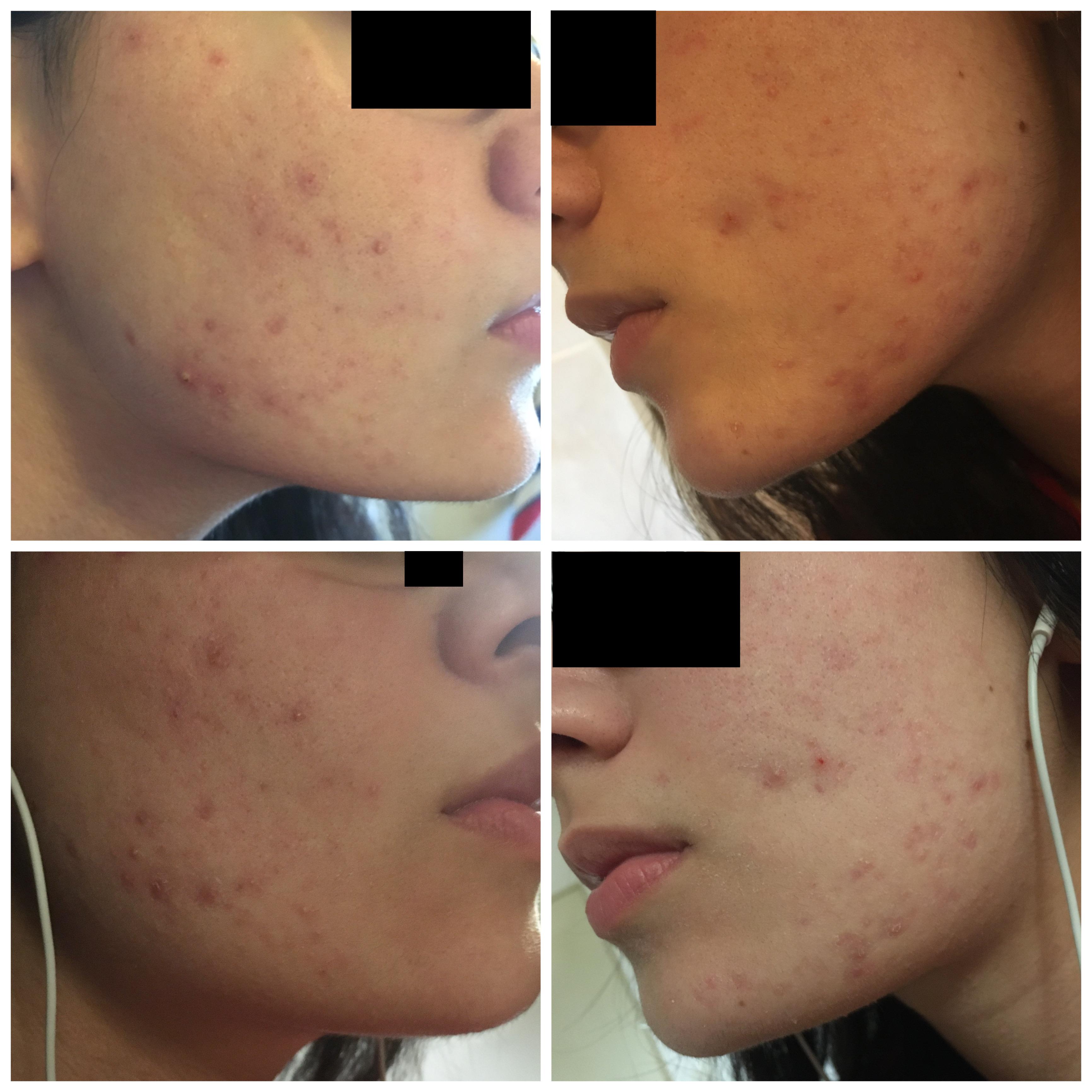 Ist Meine Akne Schlimm Soll Ich Zum Ha Gesundheit Und Medizin Gesundheit Beauty