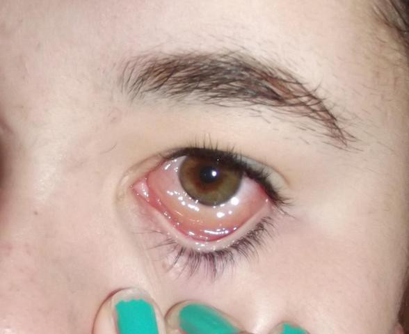 Ist Meine Bindehaut Entzundet Bild Gesundheit Und Medizin Augen Ist Meine Bindehaut Entzundet Bild Gesundheit Und Medizin Augen