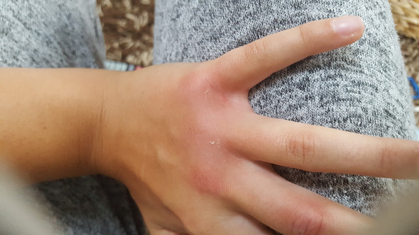 Ist meine Hand gebrochen ja oder nein? (Gesundheit und ...