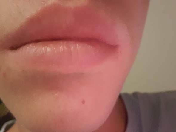 Ist meine Lippe schon seit Jahren geschwollen?