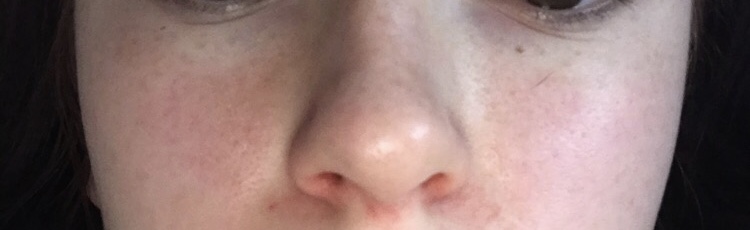 Ist Meine Nase Gebrochen Omg Gesundheit Und Medizin Gesundheit Krankheit Ist Meine Nase Gebrochen Omg Gesundheit Und Medizin Gesundheit Krankheit