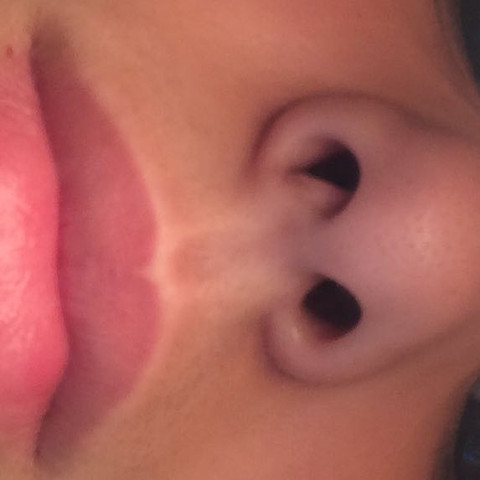 Hier seht ihr meine Nase  - (Operation, Nase, Knochen)