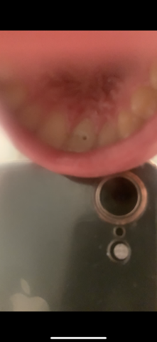 Ist meine provisorische Füllung abgefallen? Wurzelbehandlung? (Gesundheit und Medizin, Zähne ...