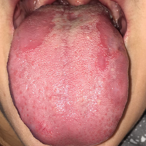 Meine Zunge mr den Flecken  - (Gesundheit und Medizin, Flecken, brennen)
