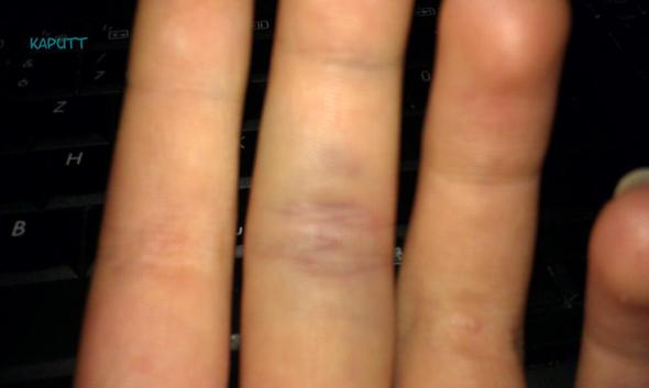 Wie Erkennt Man Ob Ein Finger Gebrochen Oder Verstaucht Ist ist meinmittelfingeringer verstaucht oder gebrochen? (Verletzung, Finger)