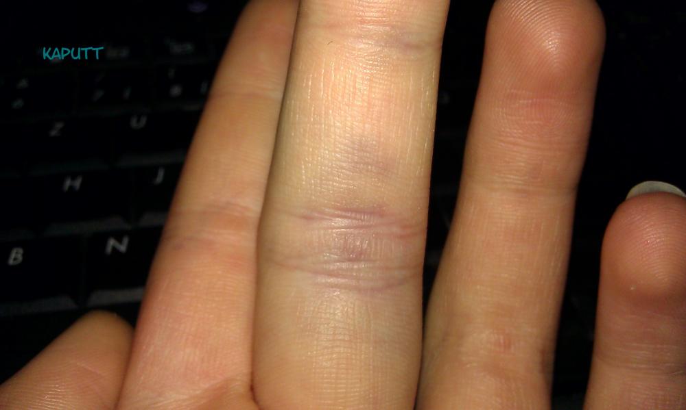 ist meinmittelfingeringer verstaucht oder gebrochen? (Verletzung, Finger)
