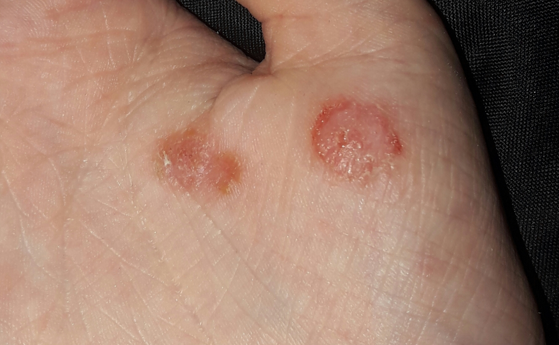 Ist sie weg (warze)? (Haut, Warzen) Ist sie weg (warze)? (Haut, Warzen)