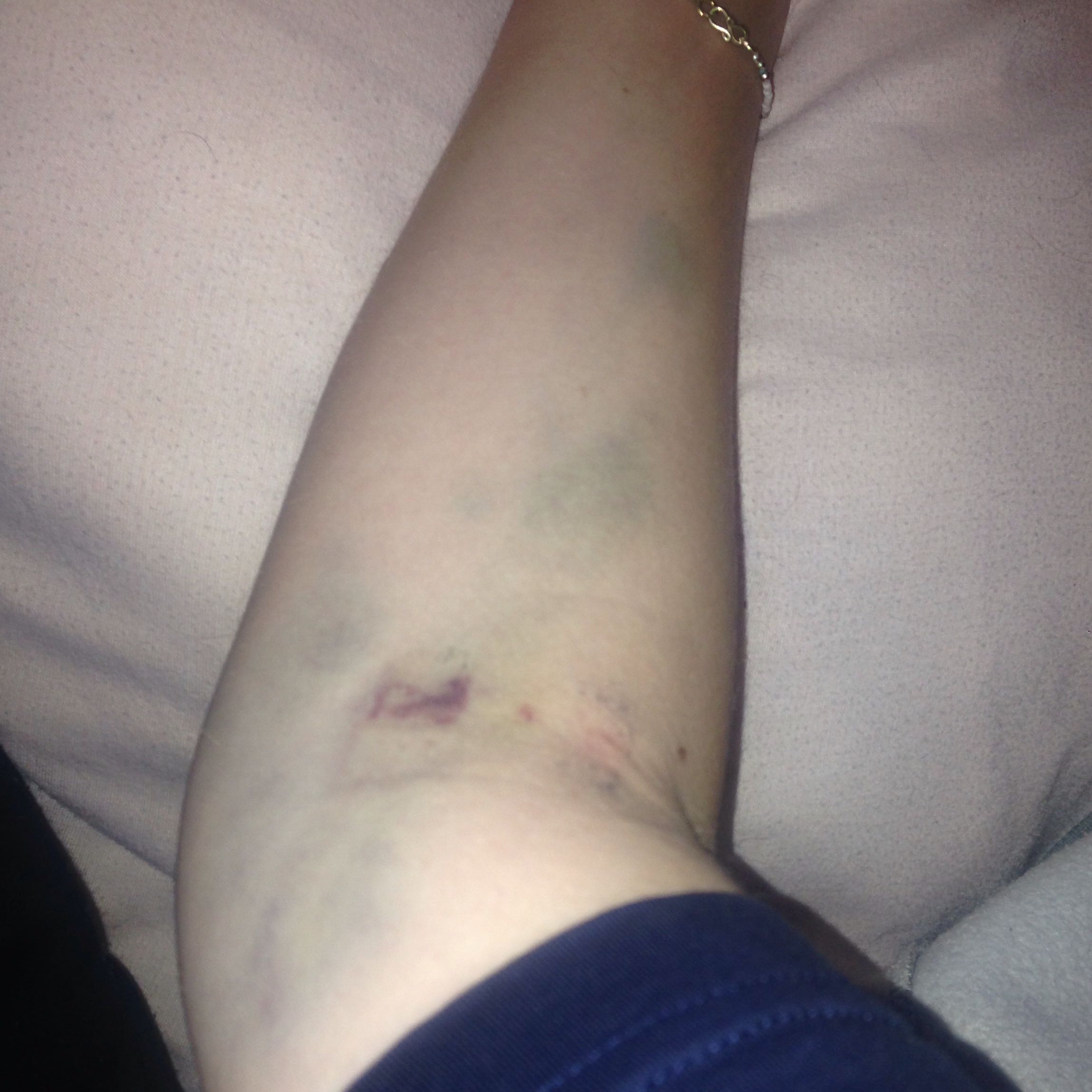 Ist So Ein Arm Nach Der Blutabnahme Blaue Flecken Ist So Ein Arm Nach Der Blutabnahme Blaue Flecken