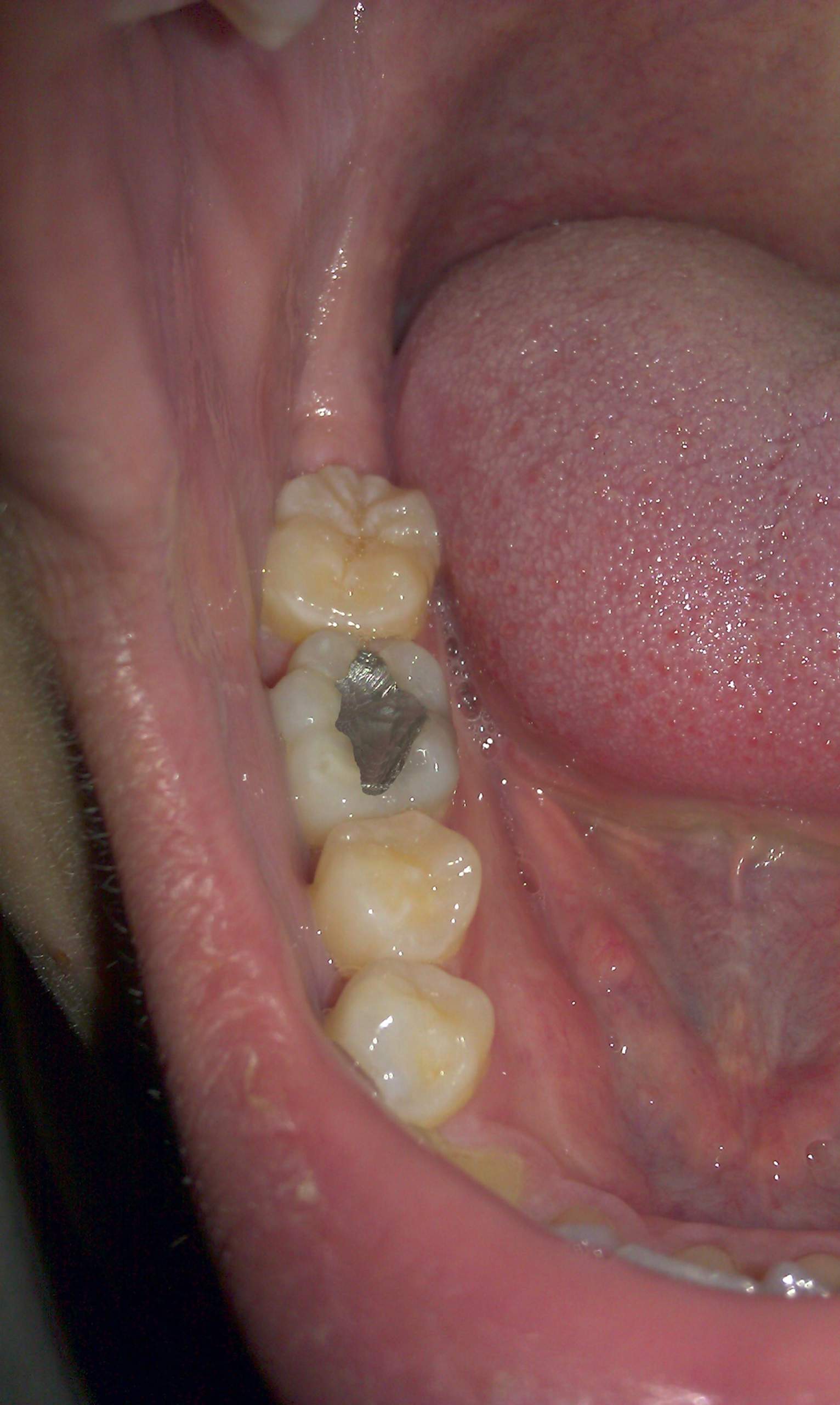 Ist so eine Plombe normal? (Zähne, Zahnarzt)