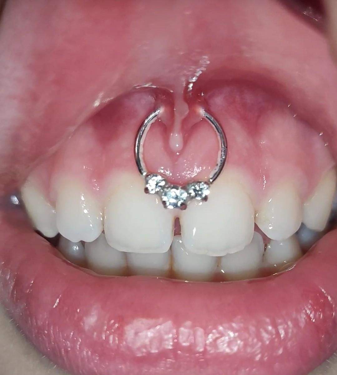 it mein lippenbandchenpiercing entzundet piercing lippenbandchen