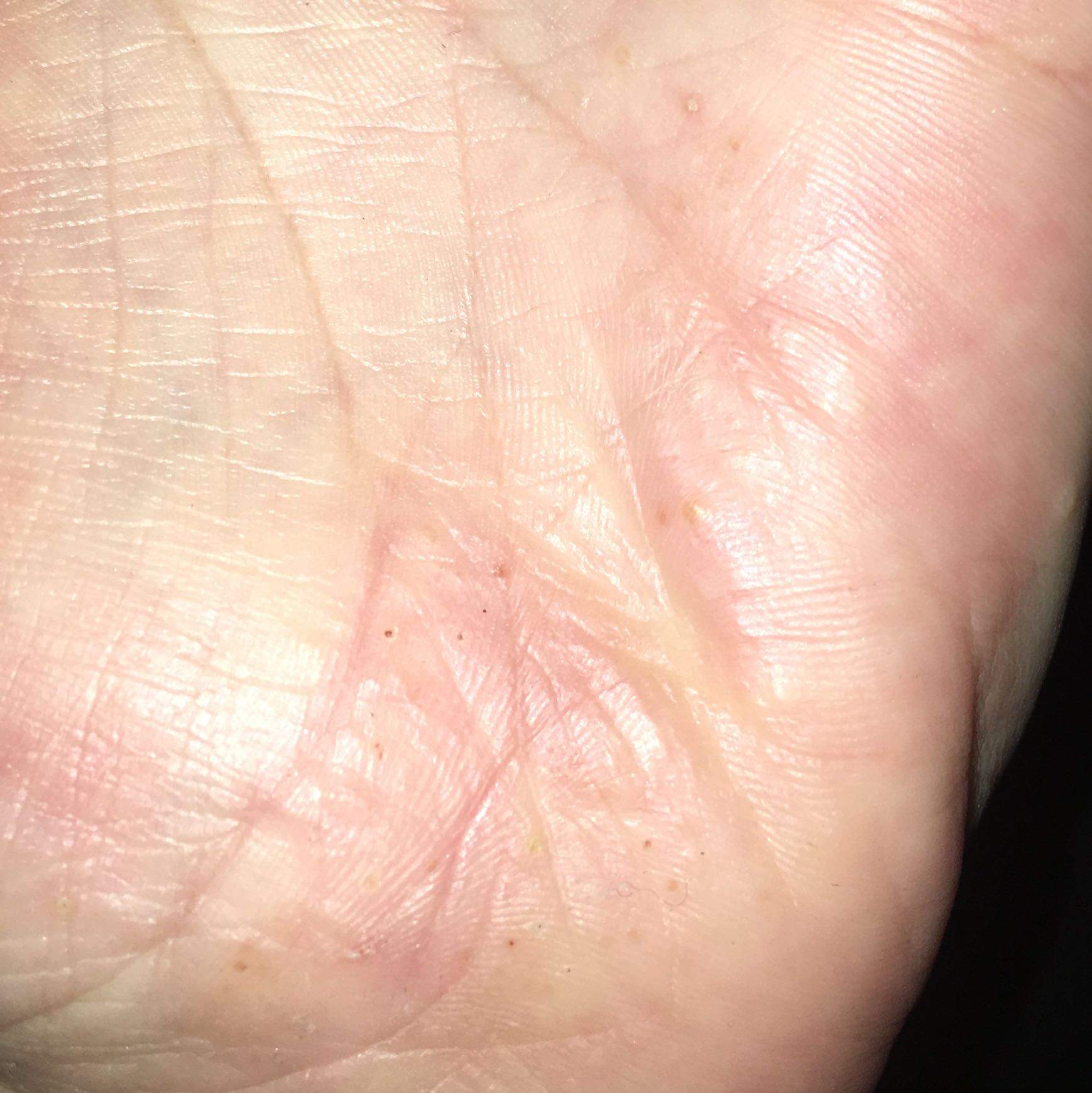 Jedes Jahr Bläschen an den Händen nur im Sommer? (Allergie, Hand, Ausschlag) Jedes Jahr Bläschen an den Händen nur im Sommer? (Allergie, Hand, Ausschlag)