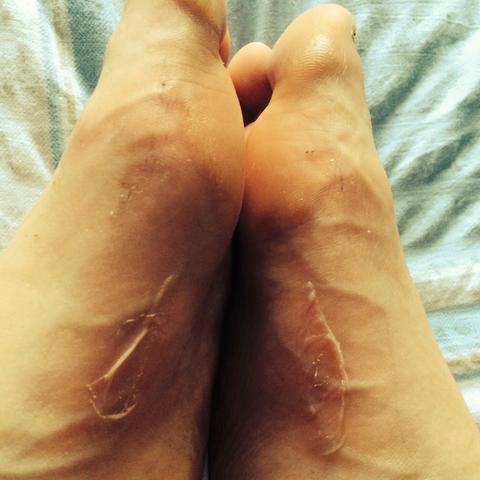 Jogging Was Tun Bei Blasen Am Spann Fuss Sport Medizin Arzt Jogging Was Tun Bei Blasen Am Spann Fuss Sport Medizin Arzt