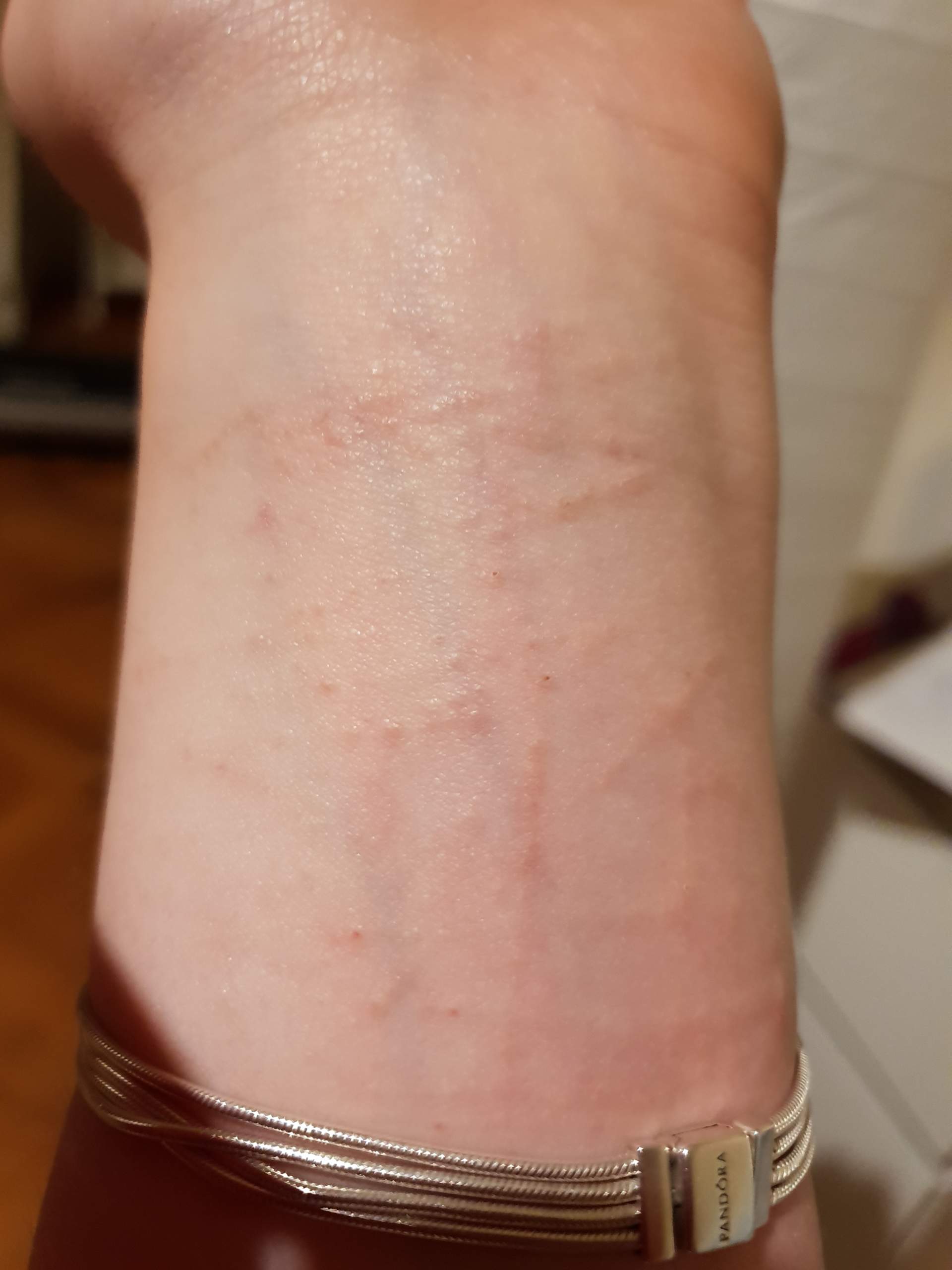 Jucken , Pickel,Linien, was ist das? (Parasiten, Milben, Krätze) pickel jucken