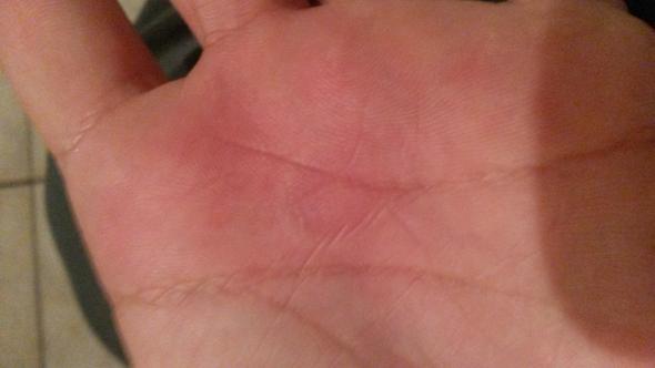 Jucken An Den Handen Haut Allergie Hand Jucken An Den Handen Haut Allergie Hand