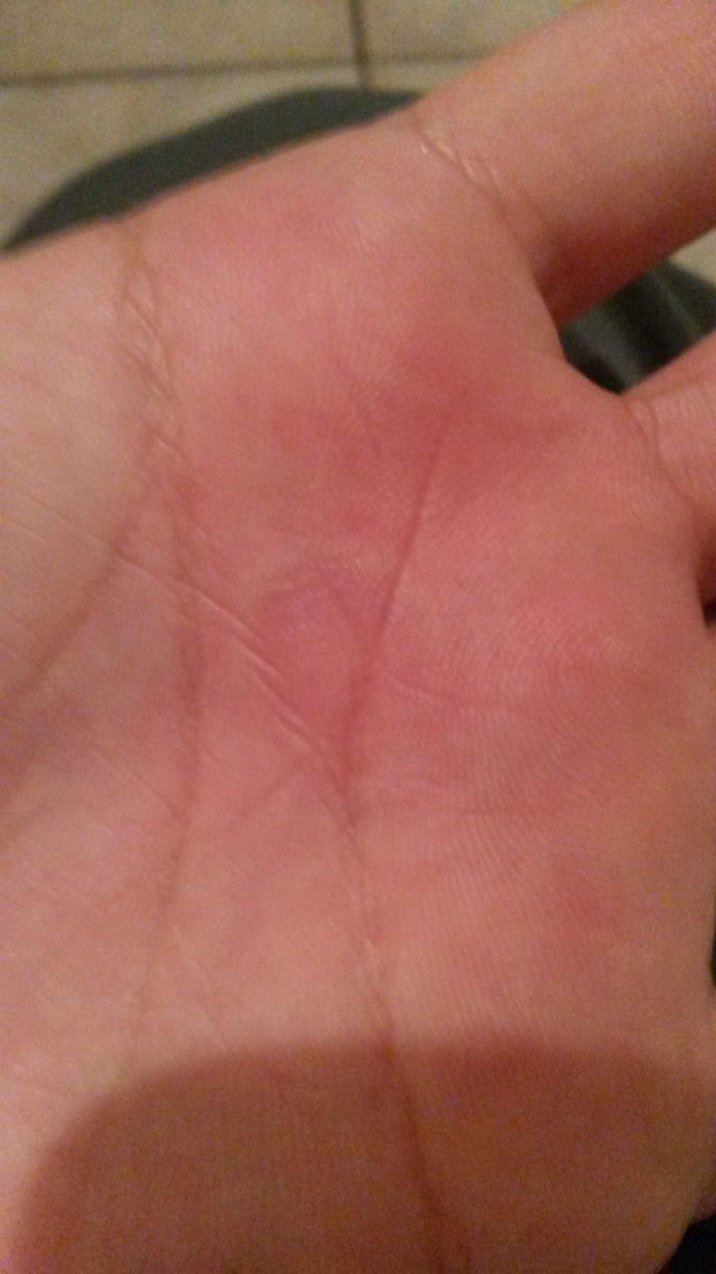 Jucken an den Händen (Haut, Allergie, Hand)