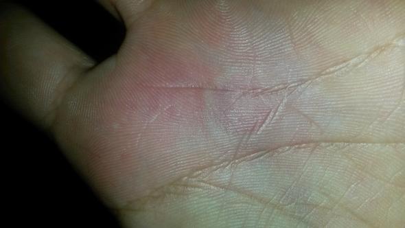 Hand 2 - (Haut, Allergie, Hand)