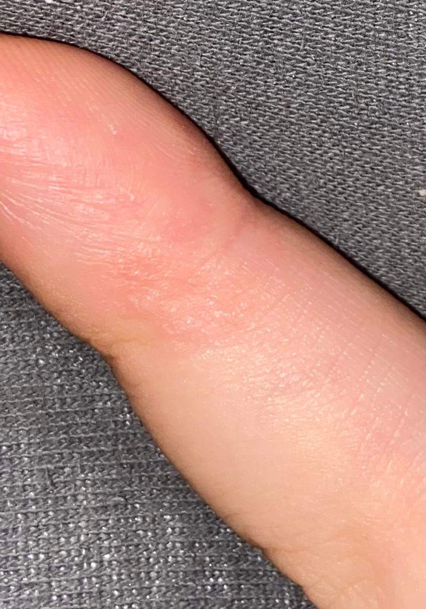 Jucken und kleiner auschlag am Finger? (Gesundheit und Medizin, Gesundheit, Hautarzt) Jucken und kleiner auschlag am Finger? (Gesundheit und Medizin, Gesundheit, Hautarzt)