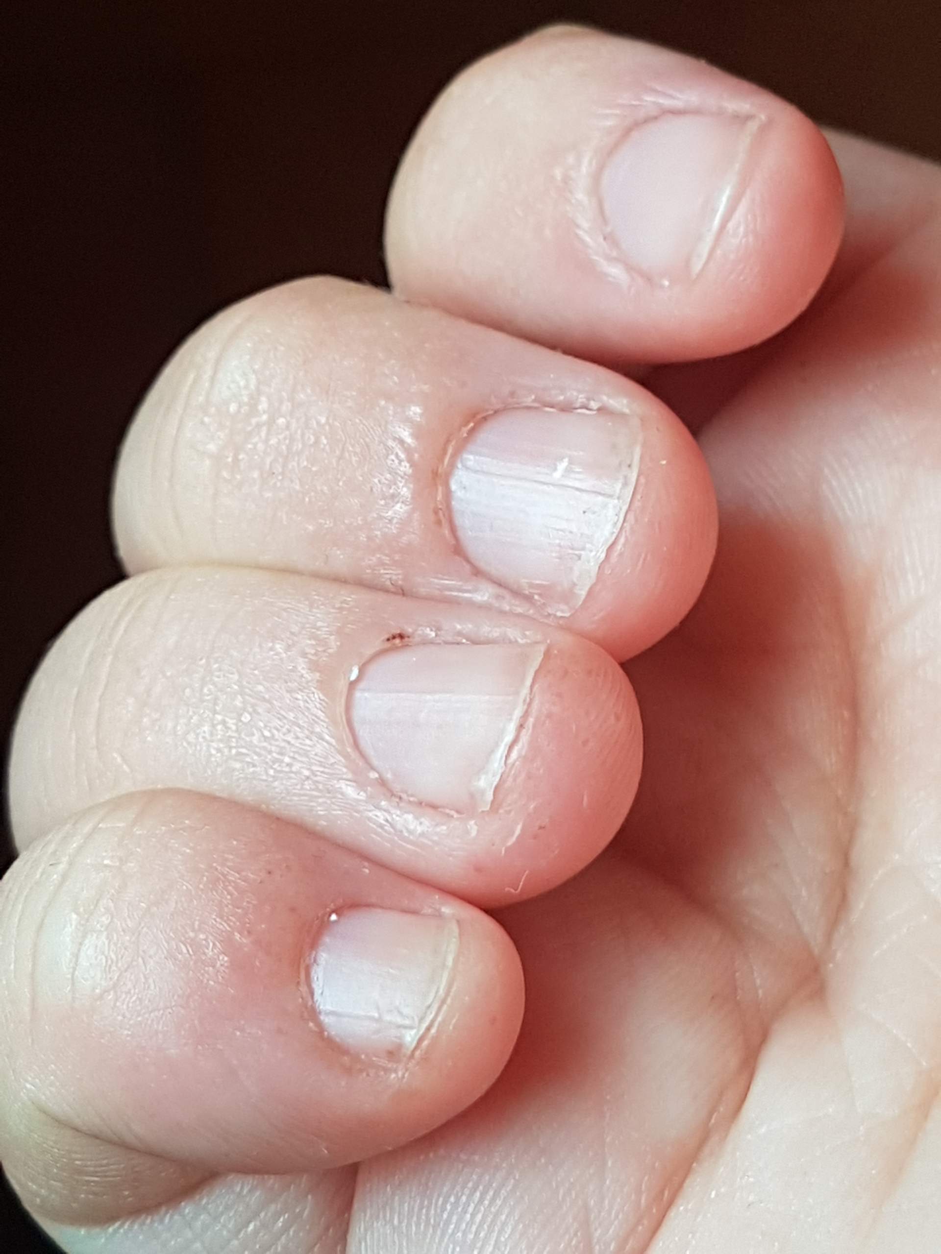 Juckende bläschen an den fingerkuppen? (Medizin, jucken, Blaeschenbildung)