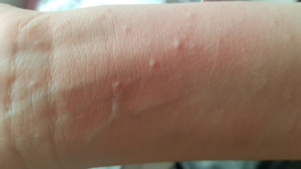 Juckende Bläschen was ist es? (Gesundheit und Medizin, Haut, Ausschlag)