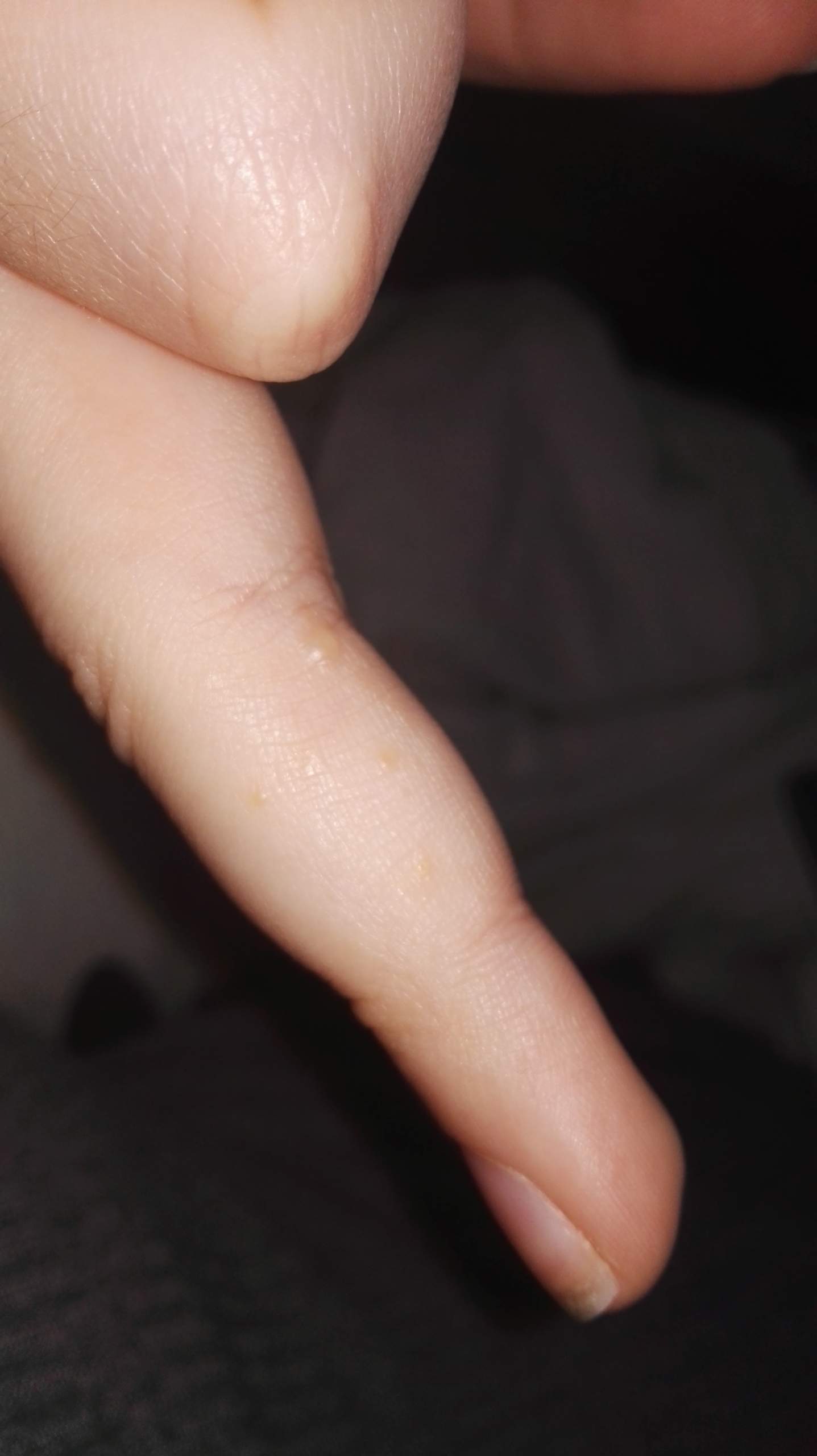 Juckende Blässchen an der Hand? (Krankheit, Haut, Juckreiz)