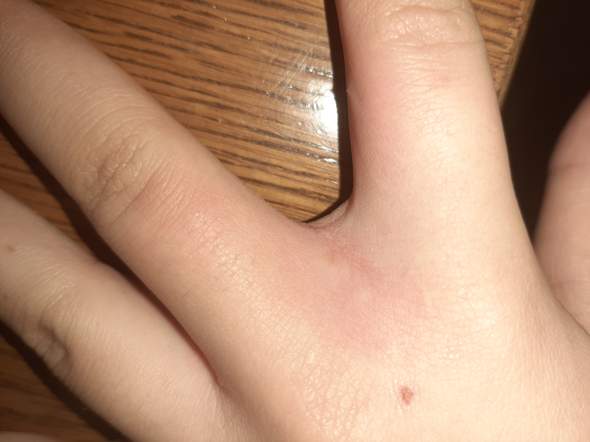 Juckende Blasen Zwischen Den Fingern Finger Juckreiz Juckende Blasen Zwischen Den Fingern Finger Juckreiz