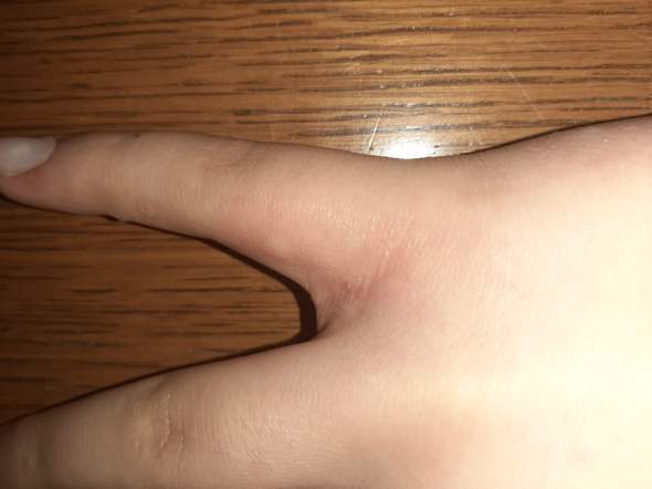 Juckende Blasen Zwischen Den Fingern Finger Juckreiz Juckende Blasen Zwischen Den Fingern Finger Juckreiz