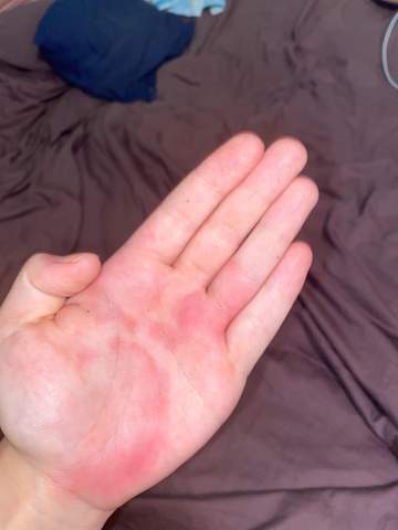 Juckende Handflachen Und Fusssolen Haut Juckreiz Juckende Handflachen Und Fusssolen Haut Juckreiz