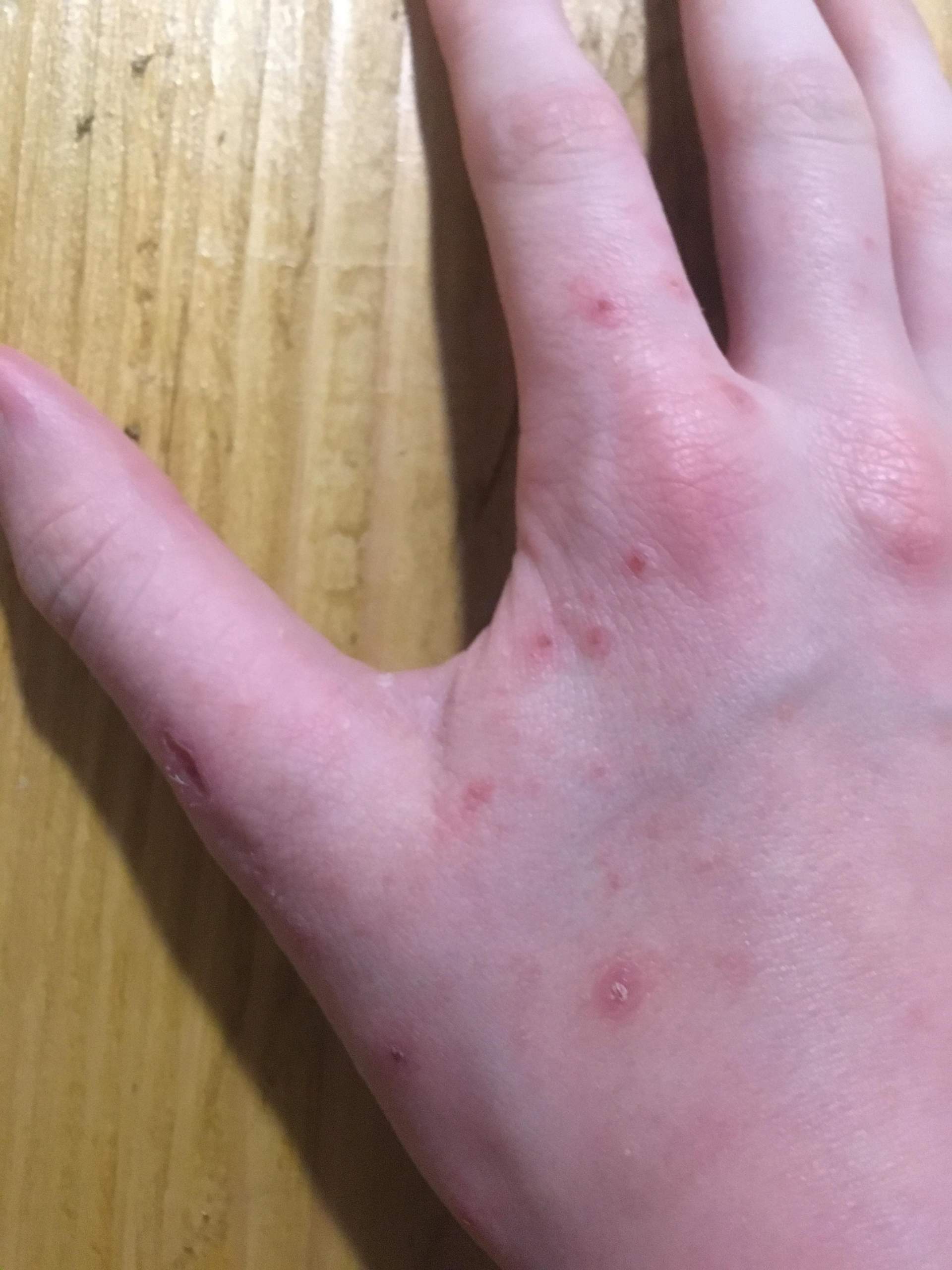 Juckende Haut Hande Beine Und Arme Juckende Haut Hande Beine Und Arme