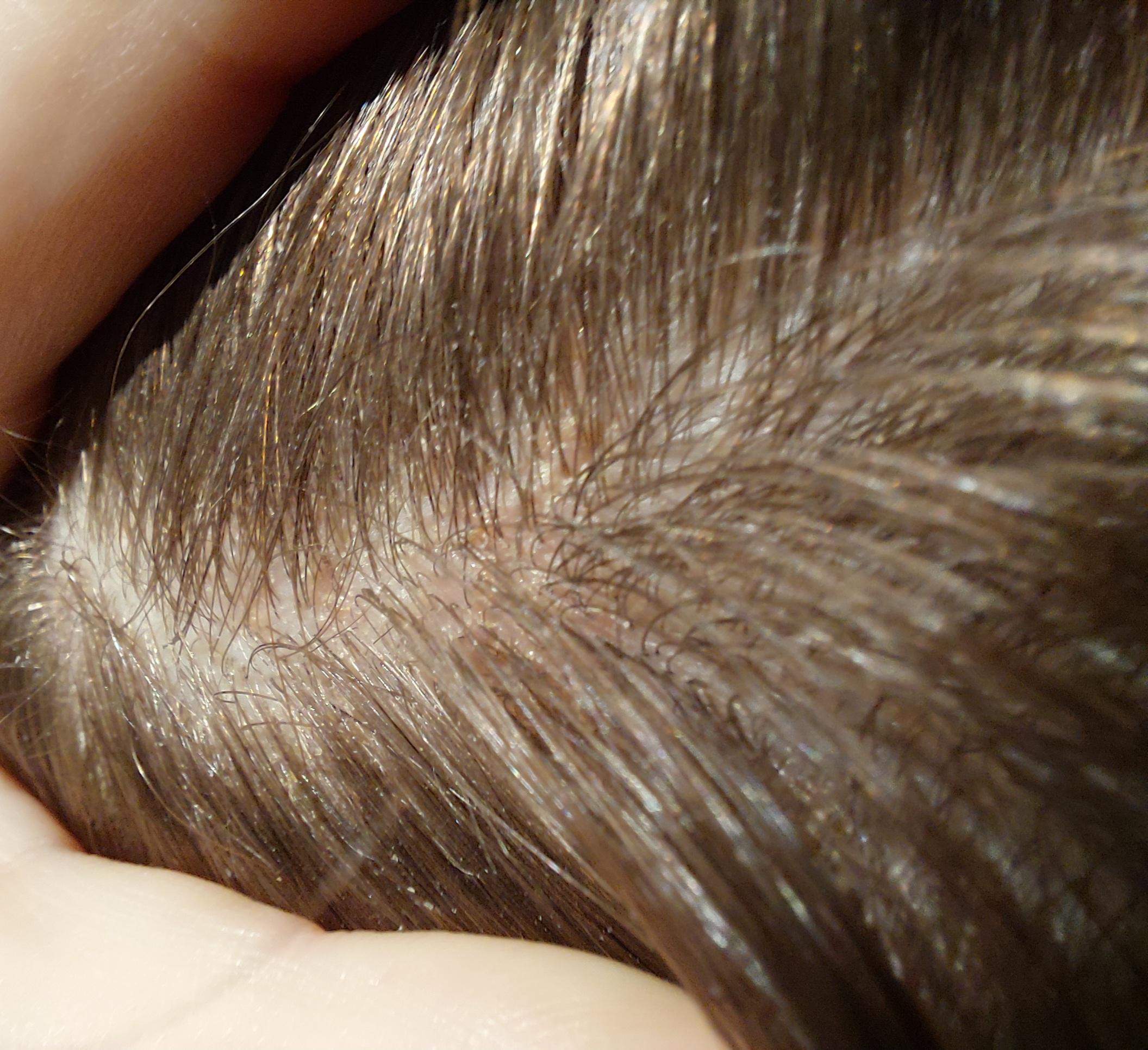 Juckende Kopfhaut, Haarausfall seborrhoisches ekzem? (Haare, Pflege, Haarpflege)