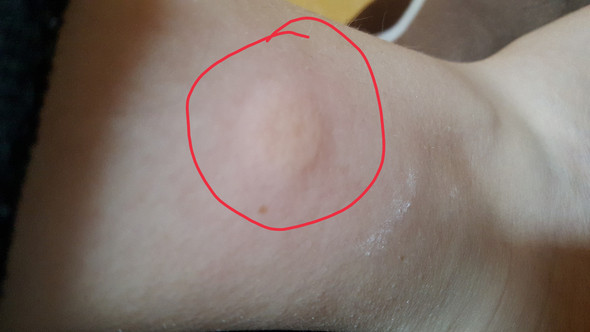 -Quaddel- - (Gesundheit, Körper, mueckenstich)