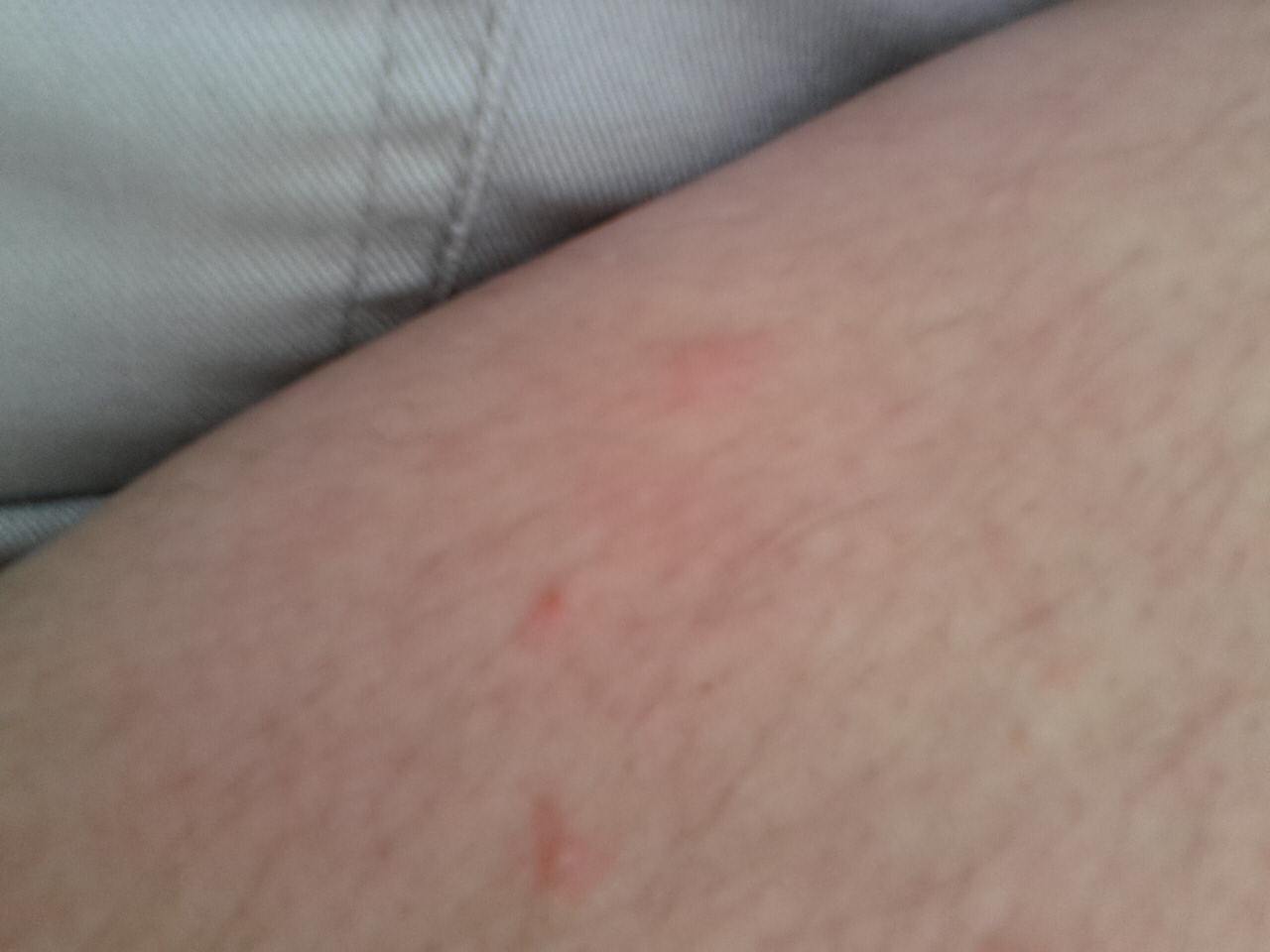 juckende Pickel am Körper. (Medizin, Haut)