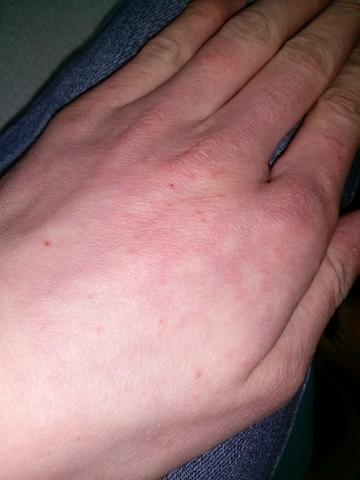Juckende Pickel An Der Hand Und Am Fuss Jucken Juckende Pickel An Der Hand Und Am Fuss Jucken