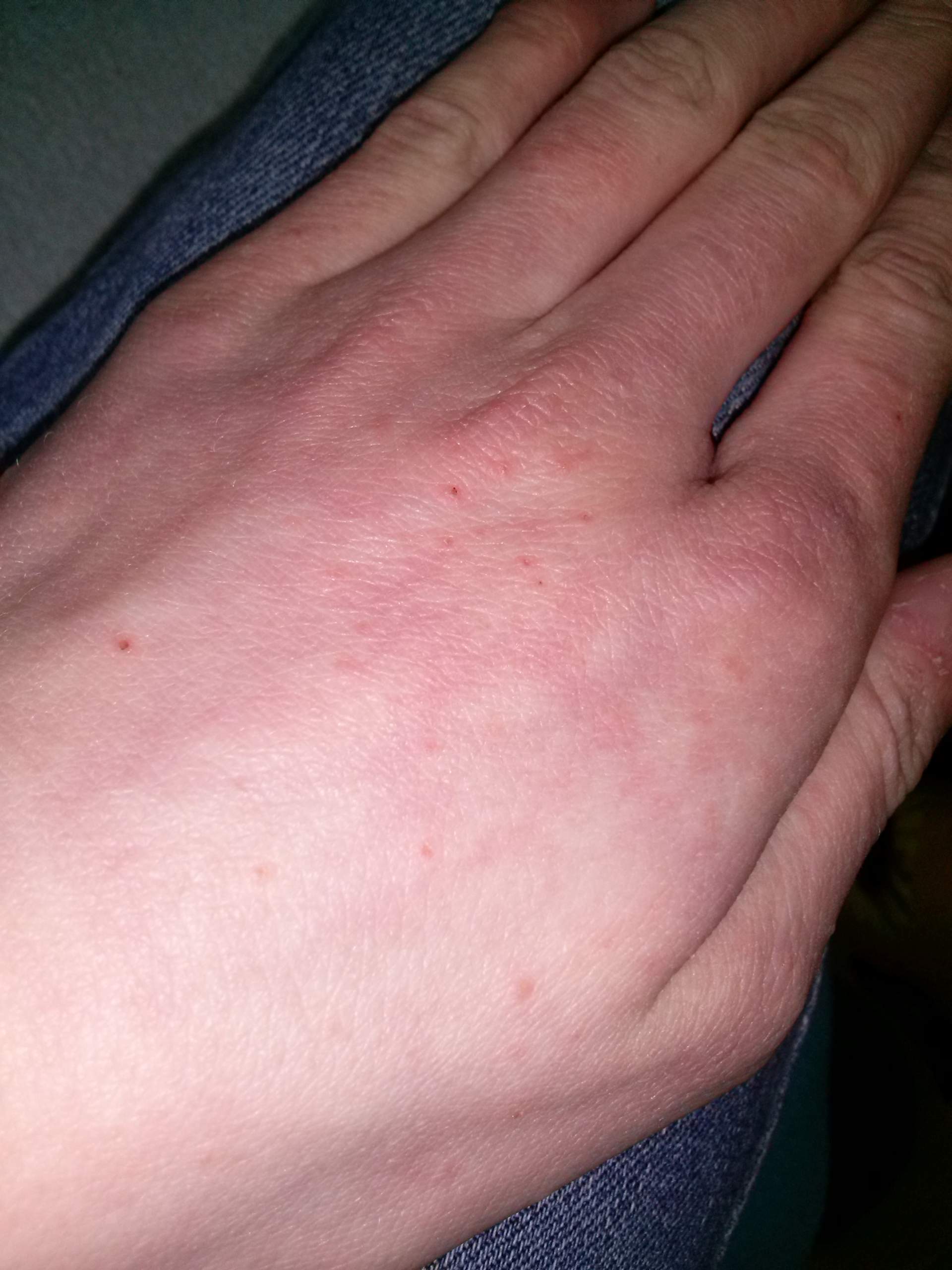 Juckende Pickel an der Hand und am FuÃ?? (jucken) pickel jucken