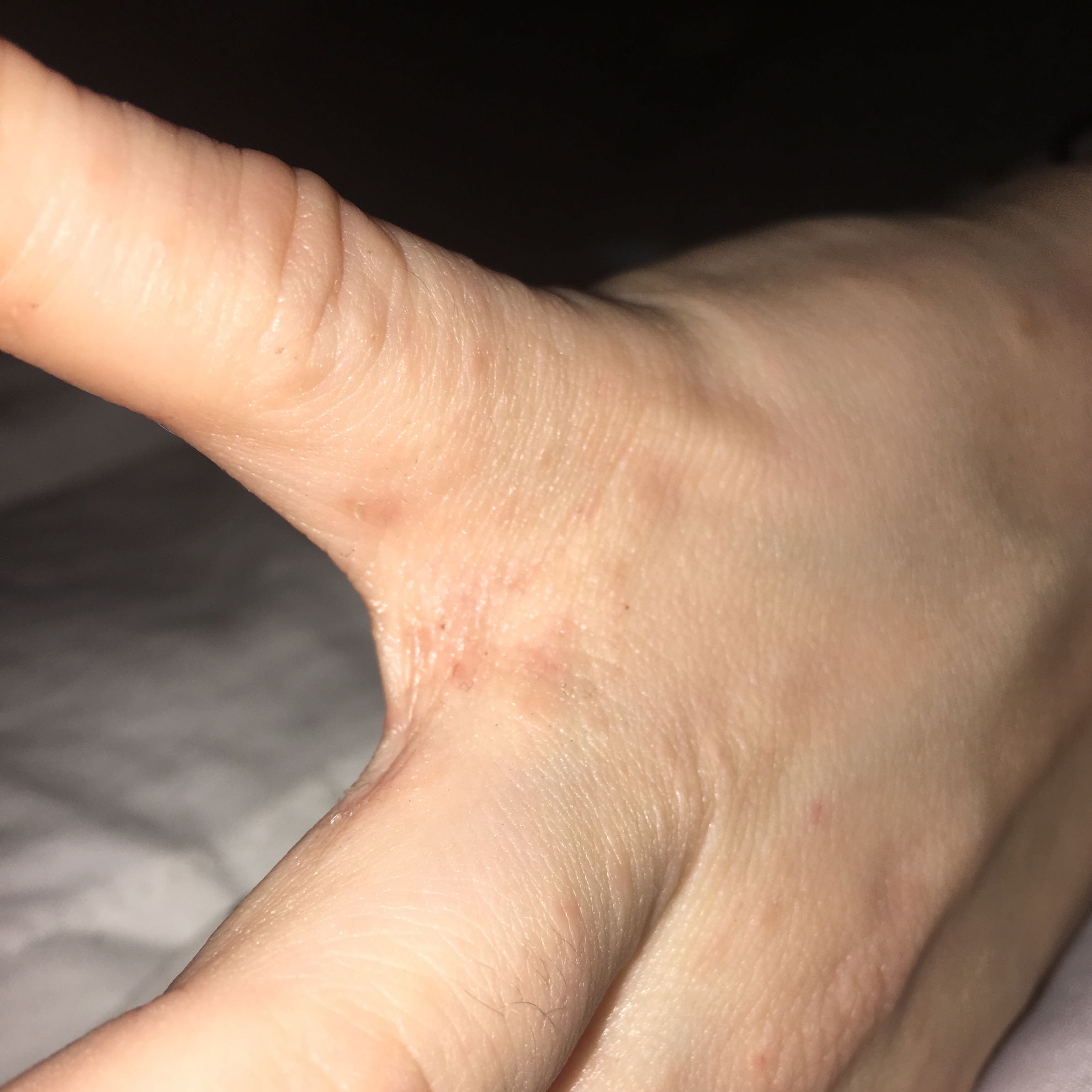 Juckende Pickel an der Hand und am Körper? (Gesundheit und Medizin, Beauty, Haut) Juckende Pickel an der Hand und am Körper? (Gesundheit und Medizin, Beauty, Haut)