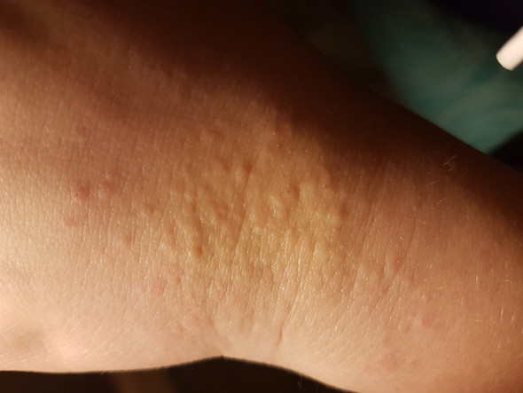 Juckende Pickel Auf Der Hand Kann Jemand Helfen Gesundheit Und Medizin Jucken Juckende Pickel Auf Der Hand Kann Jemand Helfen Gesundheit Und Medizin Jucken