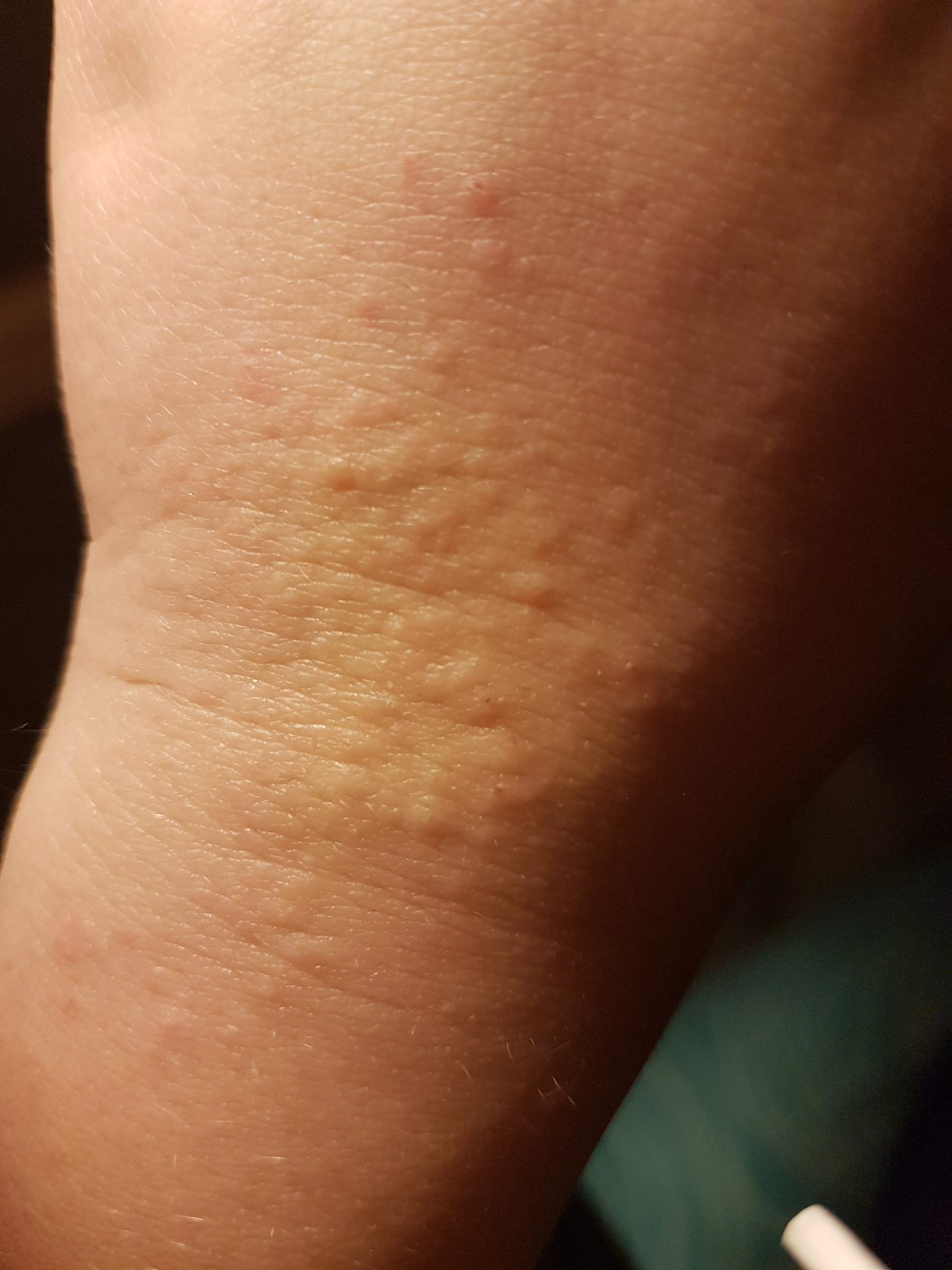 Juckende Pickel auf der Hand. Kann jemand helfen? (Gesundheit und Medizin, jucken) pickel hand