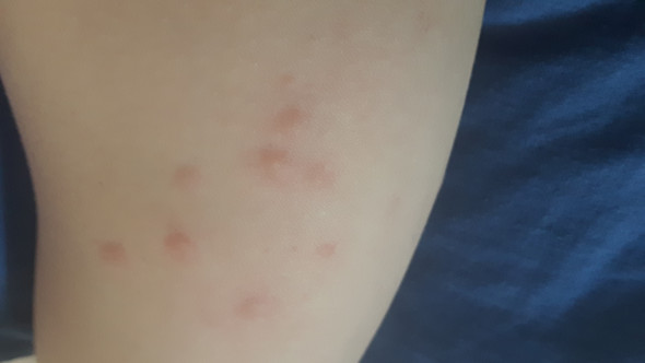 Juckende Pickel Muckenstiche Ausschlag Oder Pickel Durchs Schwitzen Gesundheit Und Medizin Arzt Jucken Juckende Pickel Muckenstiche Ausschlag Oder Pickel Durchs Schwitzen Gesundheit Und Medizin Arzt Jucken