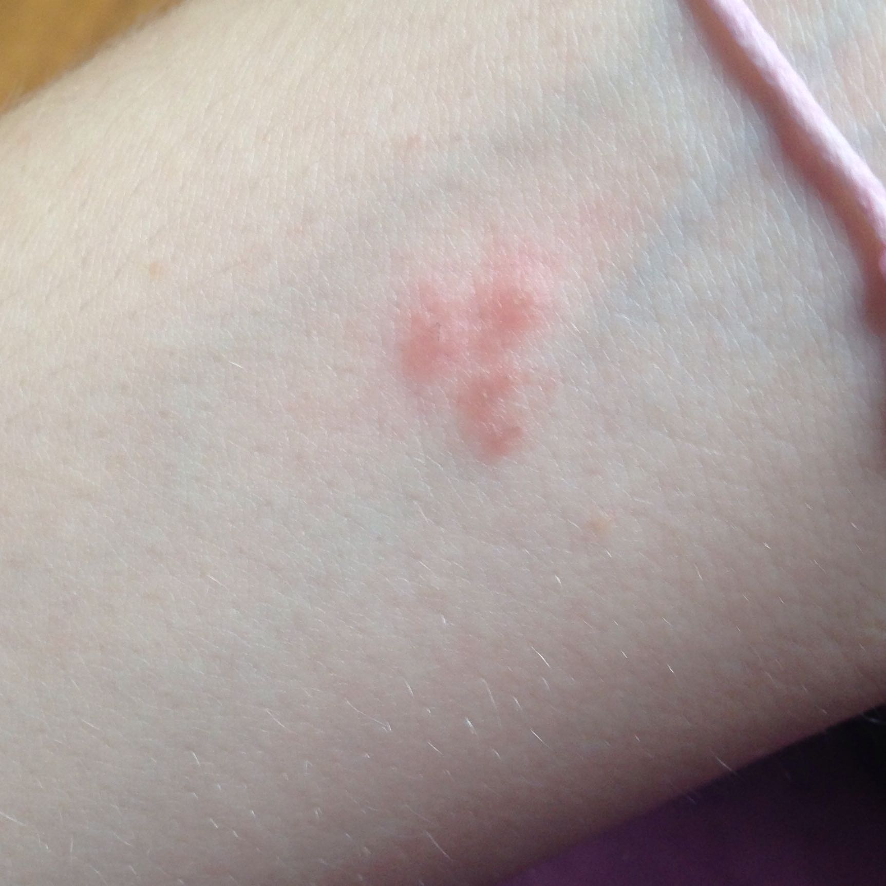 16+ Pickel Unter Der Haut Images