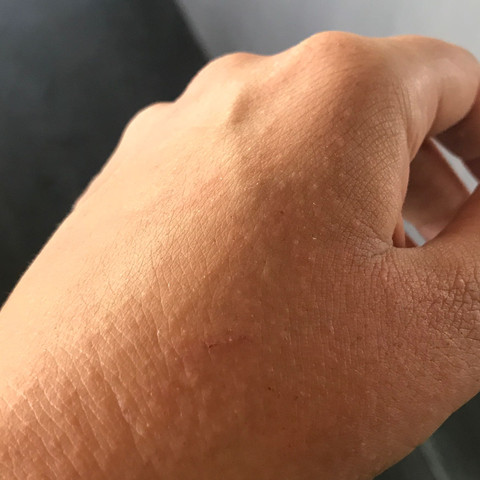 Linke Hand am 3 Tag  - (Allergie, Ausschlag)