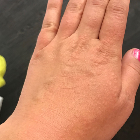 Linke Hand an 5. Tag  - (Allergie, Ausschlag)